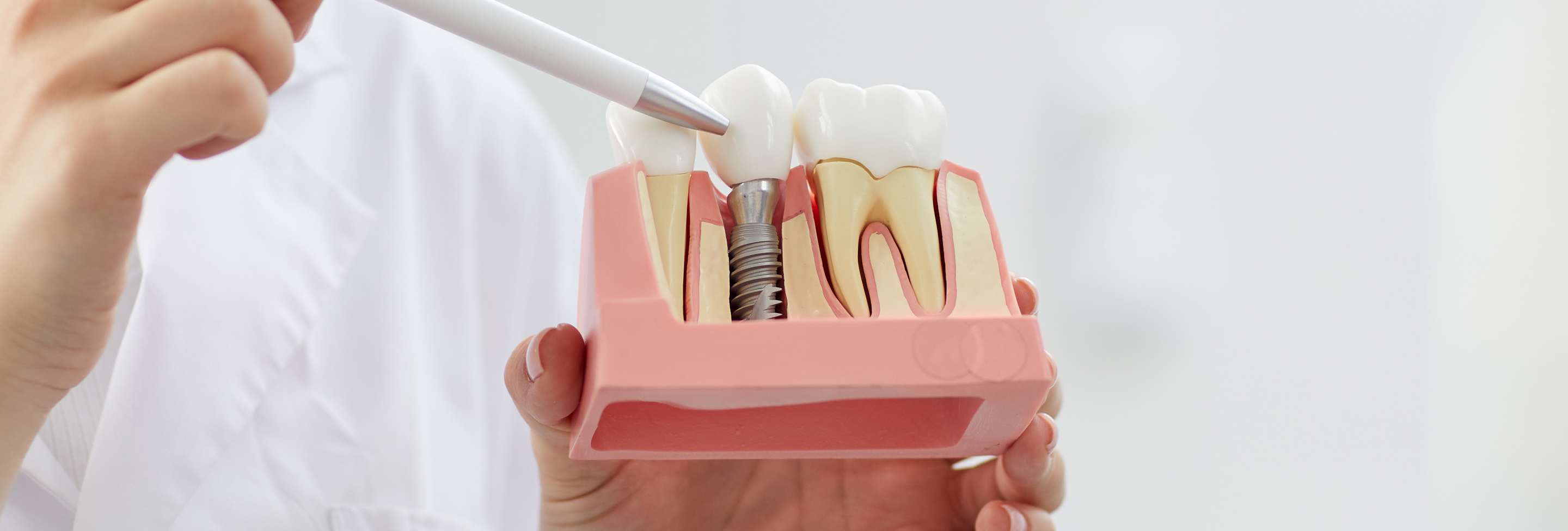 インプラント